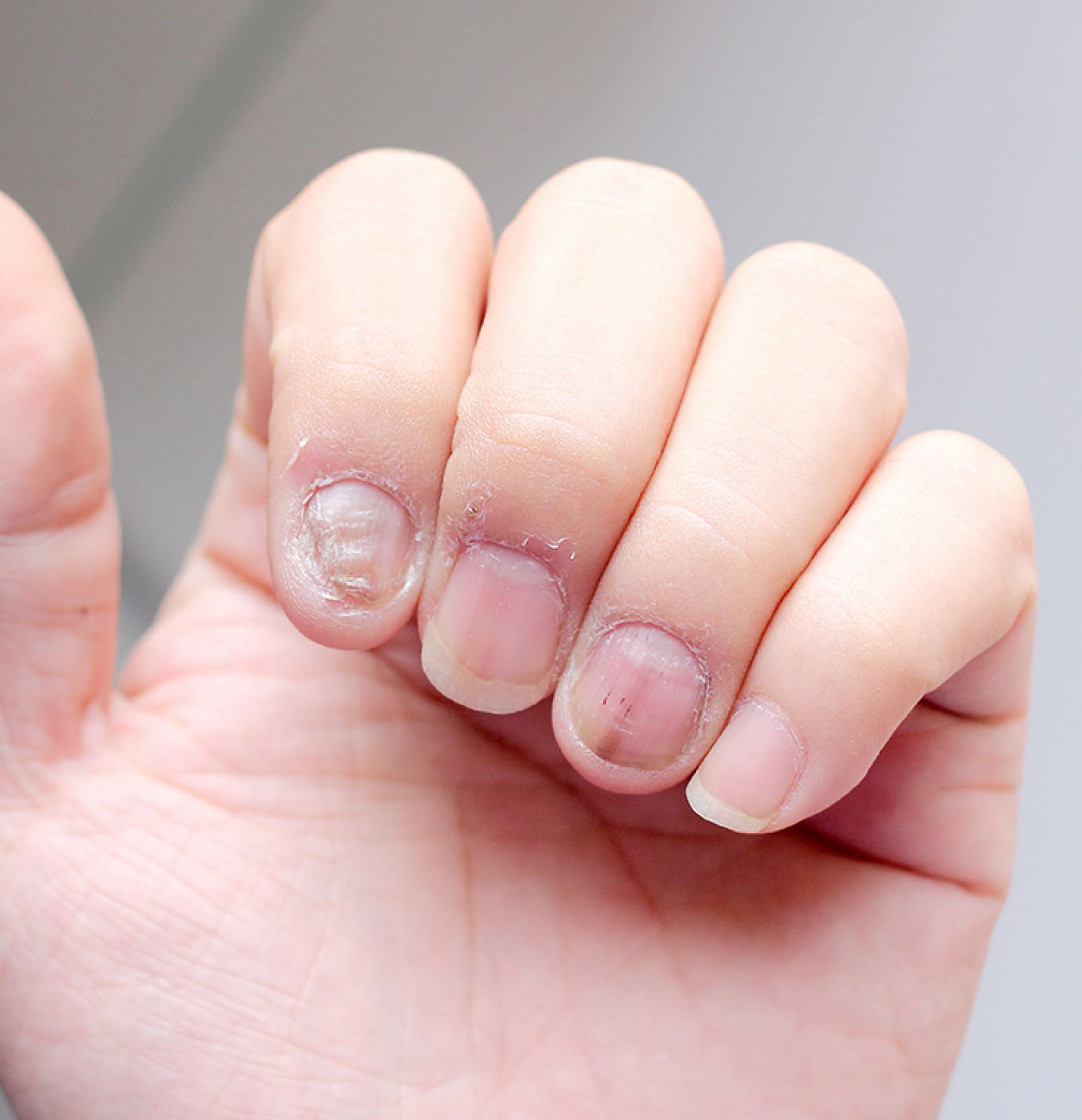 The Ultimate Nail Fungus, Nail Psoriasis, and Nail Bed Separation Cures,  Tips, and Prevention Hub - HubPages