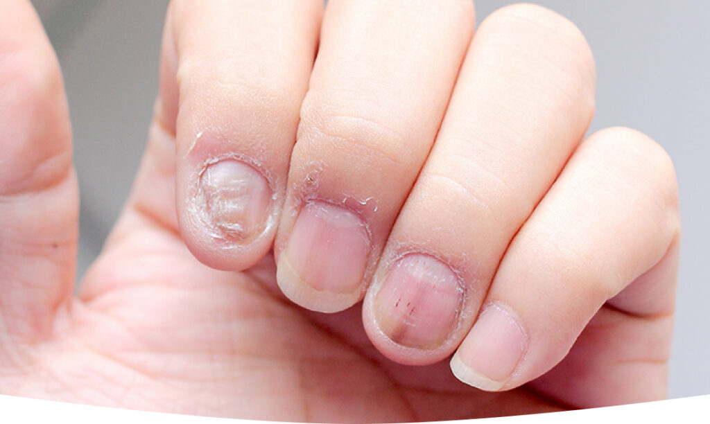 Do you bite your fingernails often? Beware, as it can cause paronychia, a  severe infection that damages nails | Health News, Times Now