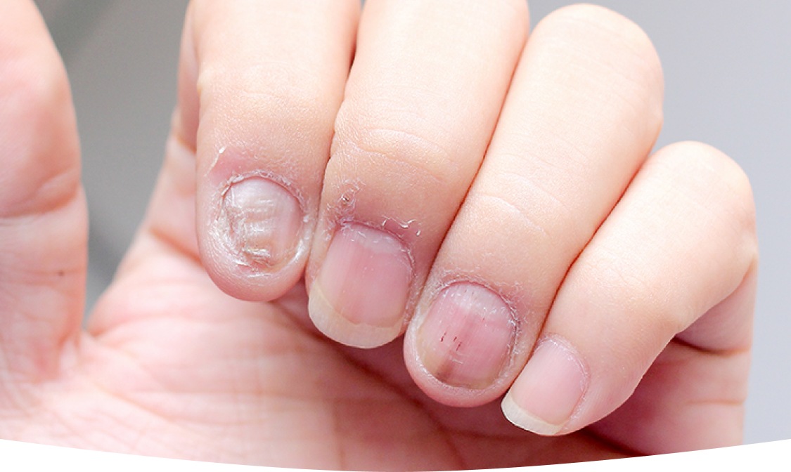 What Causes White Milk Spots on Nails