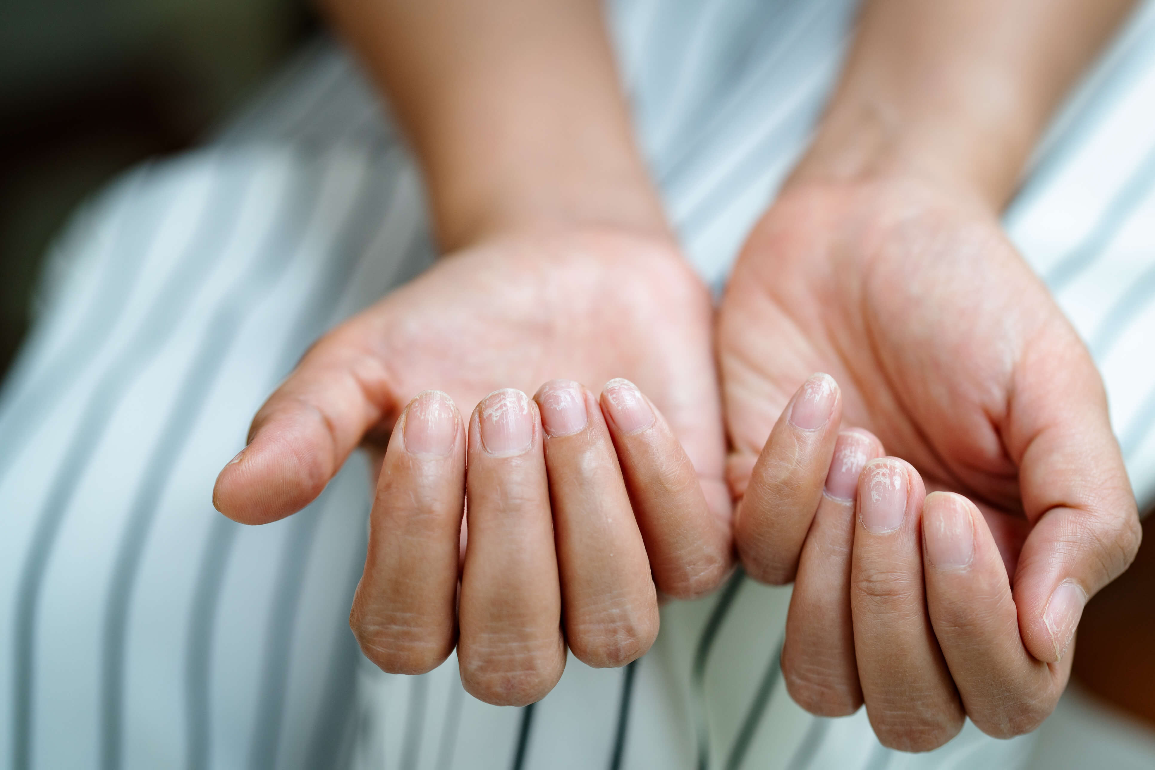 Nails: तुमची 'नखं' देतात गंभीर आजारांचे संकेत; ही लक्षणे दिसताच वेळीच व्हा  सावध! - Marathi News | Your nails give signs of serious illness as soon as  the symptoms appear Be careful |