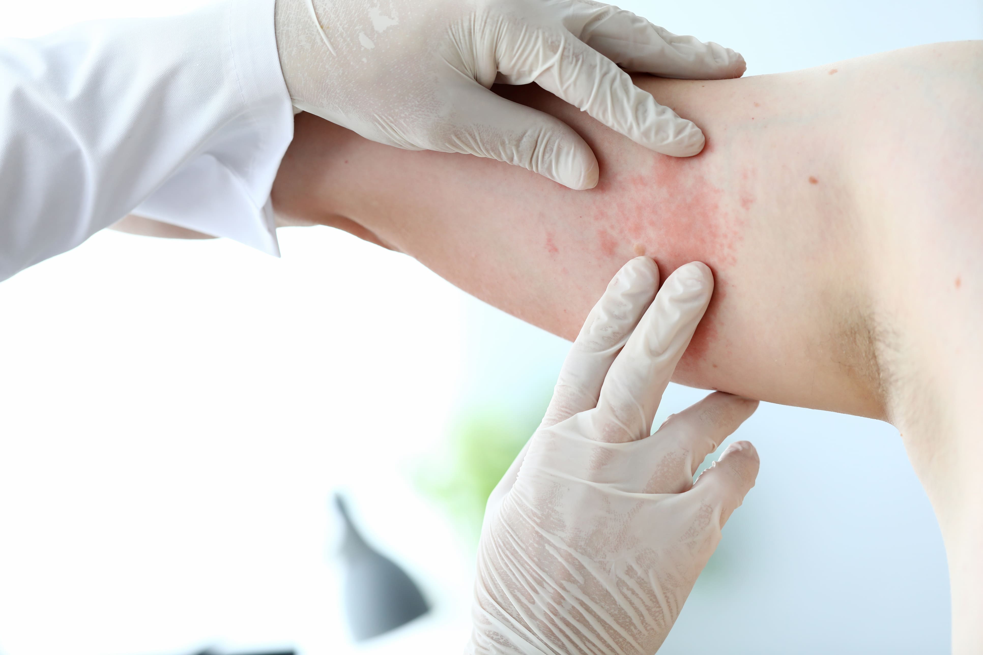 Skin Allergies - Dermatologist Singapore, Skin Specialist Clinic