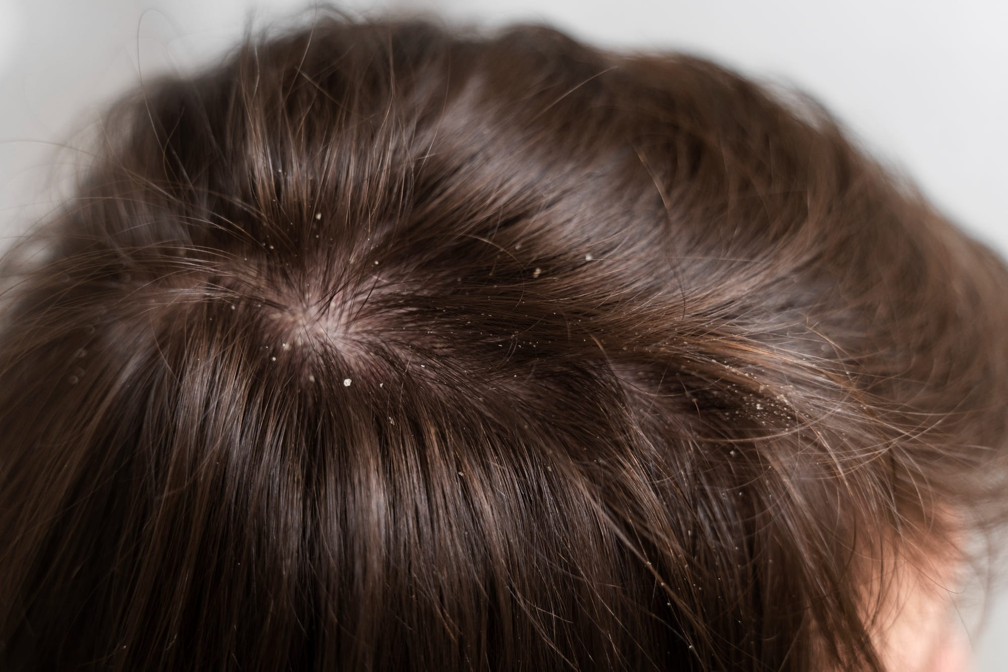Scalp Problems  Northants Hair  Scalp Clinic